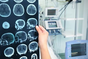 Traumatic brain injury 