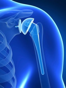 Shoulder Implant Recalled Over High Risk of Fracture