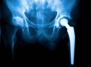 Minimal Medical Device Regulations Pose Serious Dangers to Metal Hip Implant Patients