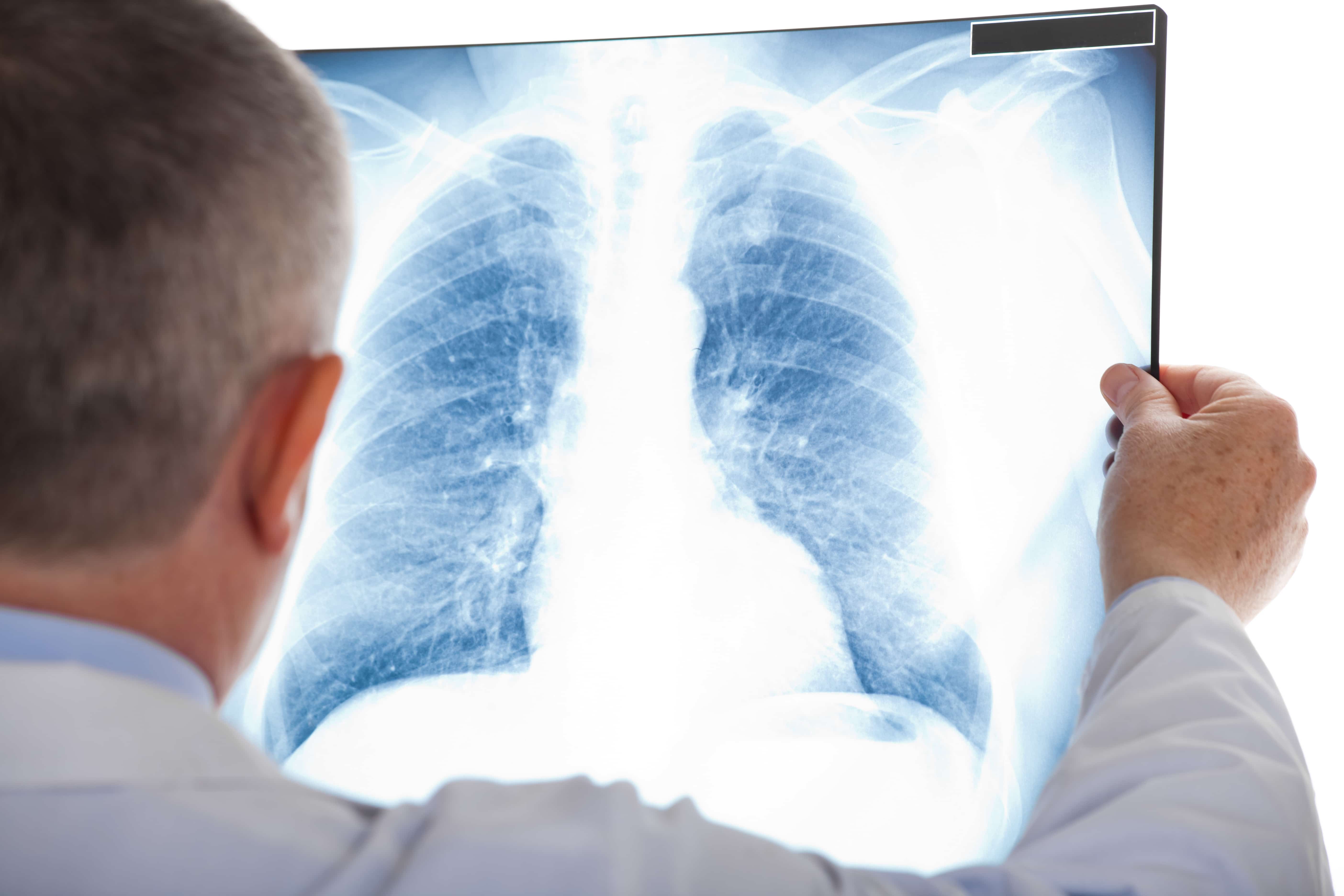 EVALI Is a Cute Name for a Life-Threatening Lung Injury