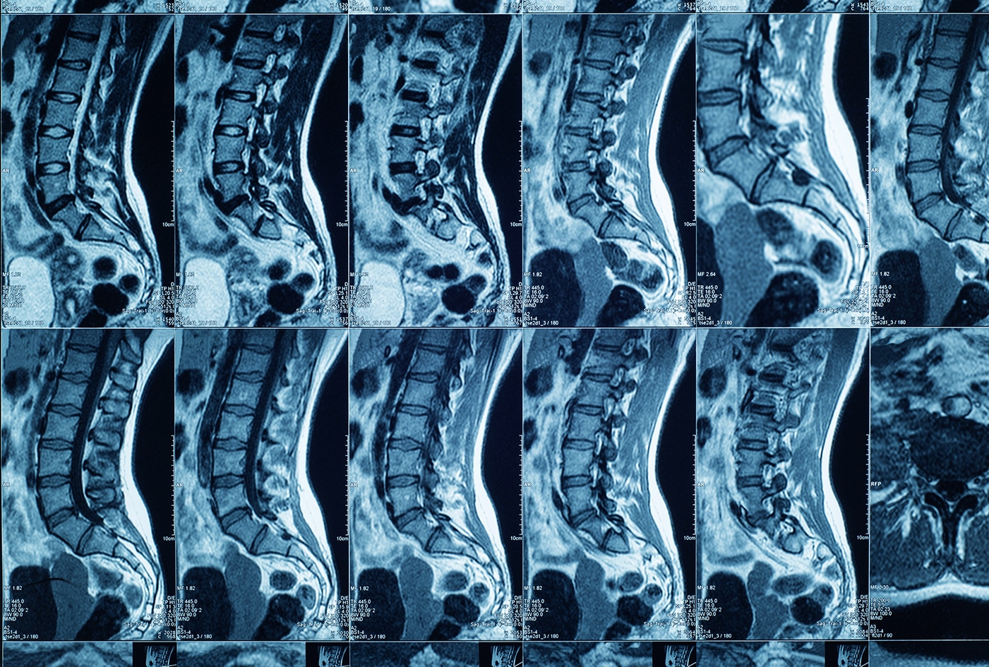 Spinal Cord Injuries