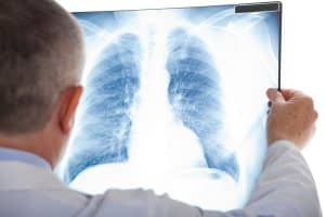 When a Car Accident Causes a Pulmonary Embolism 